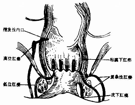 肛瘺最新治療方法，前沿技術(shù)探索與應(yīng)用