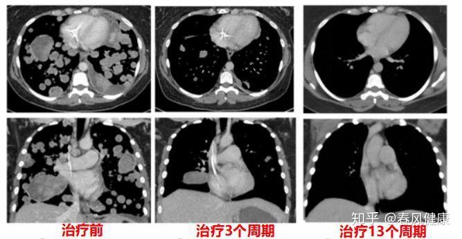 癌癥治療新突破，重塑生命之光之旅