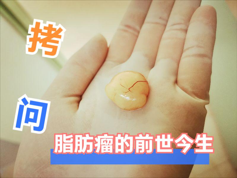 脂肪瘤 最新